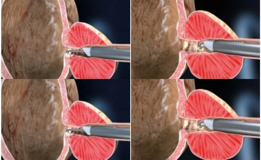 Prostat tedavisinde “plazma kinetik TUR yöntemi” ile başarılı sonuçlar alınıyor