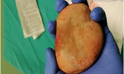 Ordu’da hastanın mesanesinden “patates büyüklüğü”nde taş çıkarıldı