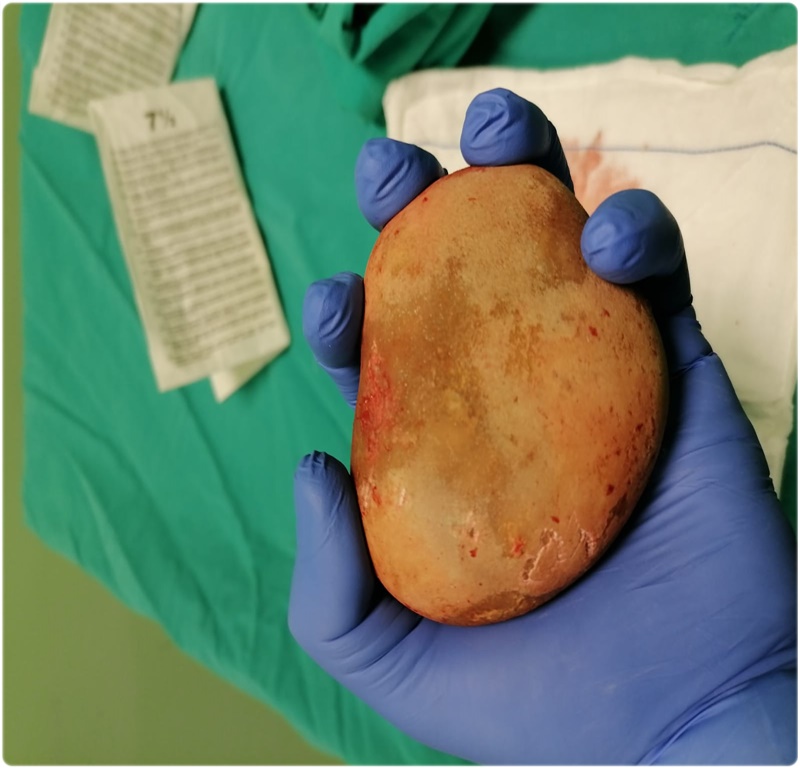 Ordu’da hastanın mesanesinden “patates büyüklüğü”nde taş çıkarıldı
